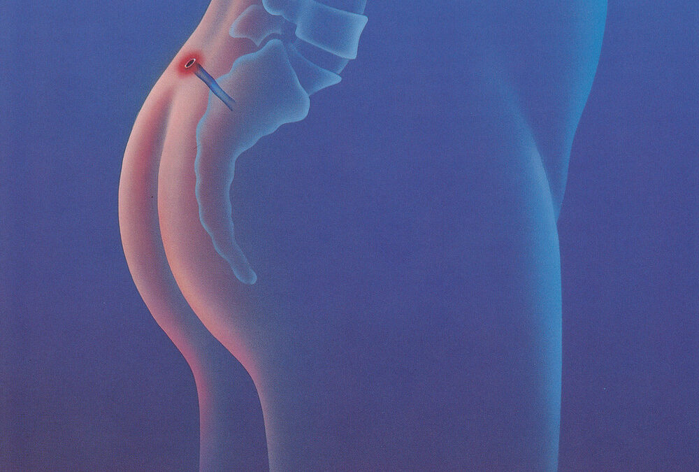 Wie funktioniert eine minimal invasive Behandlung von Steißbeinfisteln? (Sinus pilonidalis)