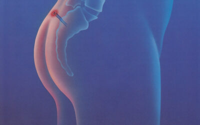 Wie funktioniert eine minimal invasive Behandlung von Steißbeinfisteln? (Sinus pilonidalis)